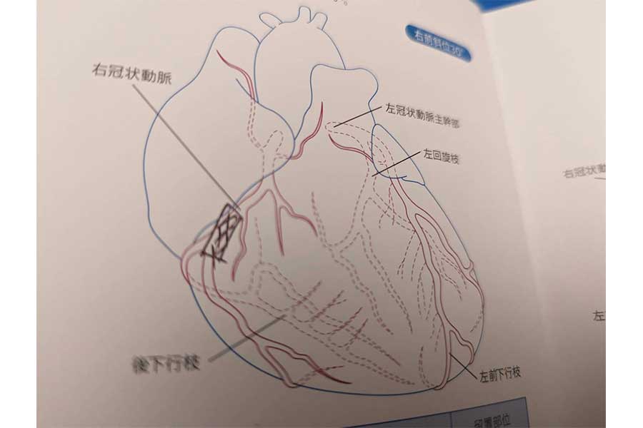 右心房の血管が詰まっていた【写真：本人提供】