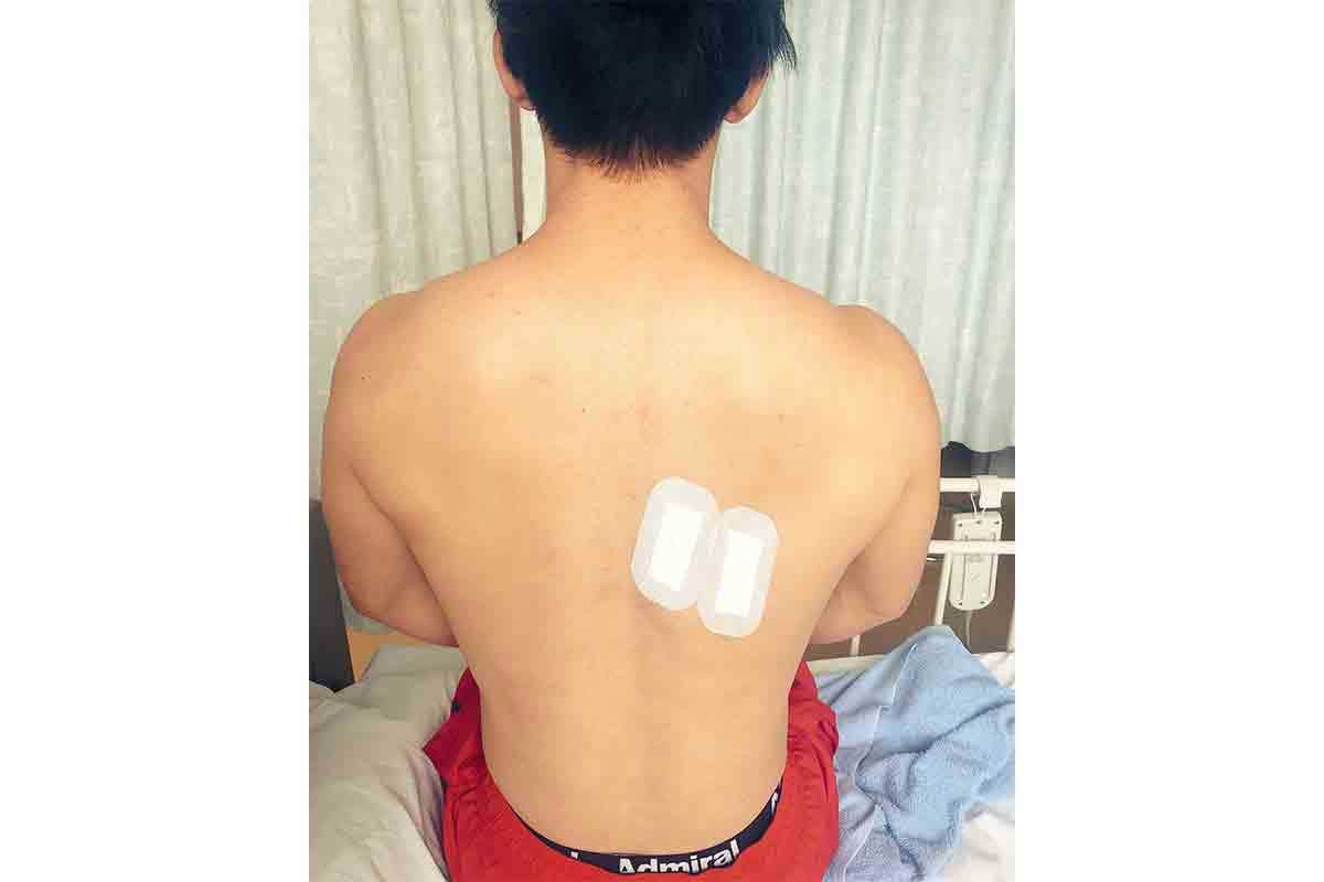 背中から針を入れる肺の手術は保険対象外だった