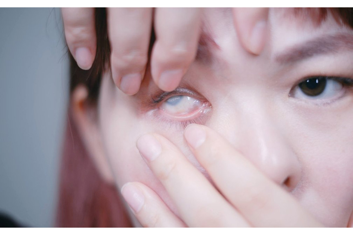 片目失明でも「障がい者ではない」日本の制度　被せ義眼は“美容扱い”「医療的必要性が軽視される」