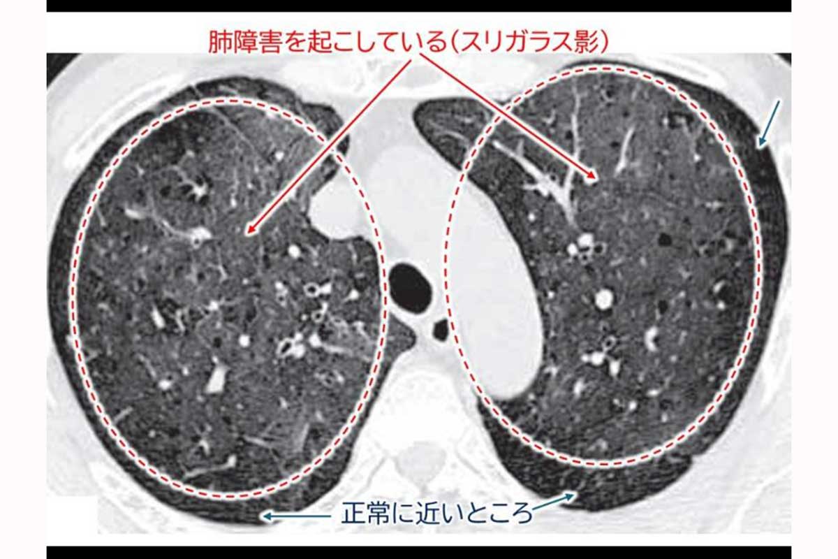 肺障害を起こしている状態(スリガラス影)【写真:X(@lungdrnot)より】