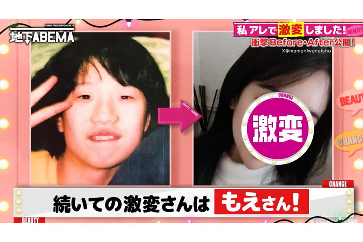 学生時代に周りから「ブス」→1300万円整形で“韓国女優”顔に大変身　ビフォーアフターにスタジオ騒然