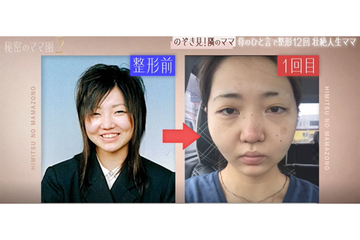 整形12回で総額1000万円超　えら、ほお、あごの骨切り大手術へて激変　スタジオ衝撃