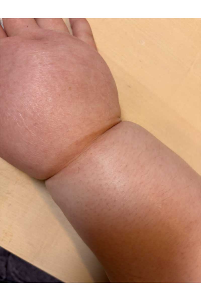 「箸持つのさえ大変」26歳・yuさんの手元