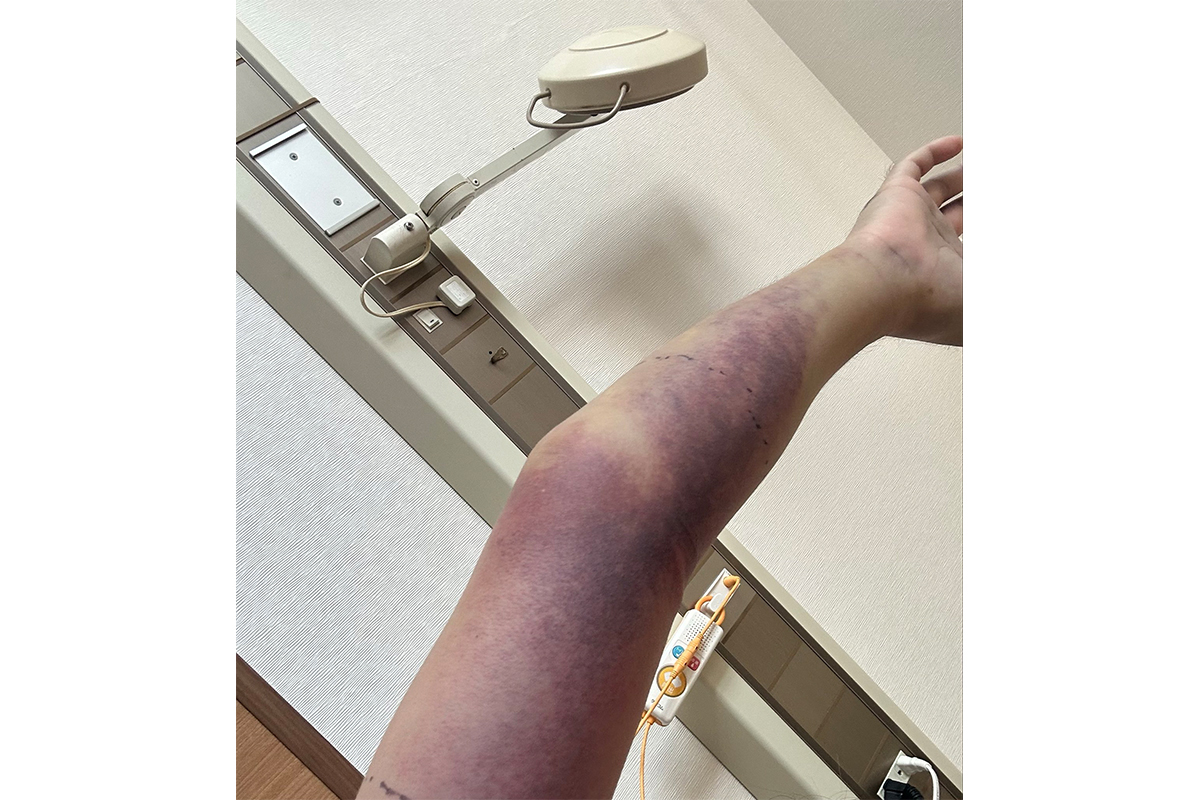「指先ちょこっと噛まれただけで、こんなになります」【写真：本人提供】